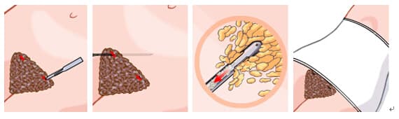 腰腹部吸脂