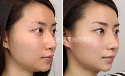 鼻梁翘,颜值爆!