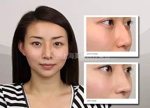 鼻梁翘,颜值爆!