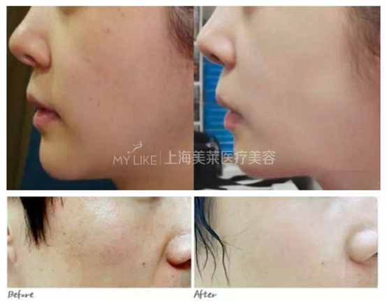 关于水光——做水光,水润过年啦!