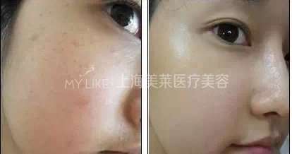 做完水光,如果停用了,皮肤是不是会比以前还差?